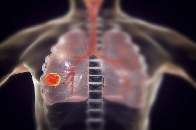 أستاذ في طب الأورام : ‘إقبال لافت للنساء على التدخين..’