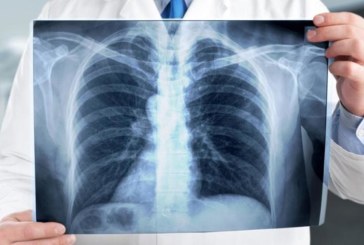 22 إصابة جديدة بالسلّ لكل 100 ألف ساكن في تونس