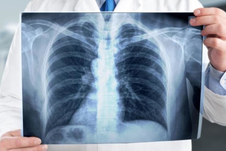 22 إصابة جديدة بالسلّ لكل 100 ألف ساكن في تونس