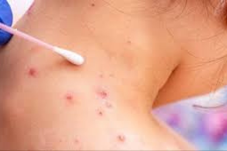 جدري القردة: روسيا تتهم أمريكا بنشر الفيروس وتُطالب بالتحقيق في 4 مختبرات أميركية في نيجيريا