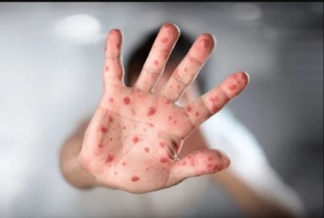 “جدري القردة”: الدكتور الغزال يدعو إلى اليقظة واتخاذ جملة من التدابير