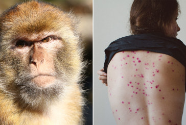 الصّحة العالمية تؤكد ظهور 80 إصابة مُؤكّدة بجدري القرود في العالم