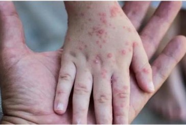 مختص في علم الفيروسات: تونس لازالت في مأمن من “جدري القردة”