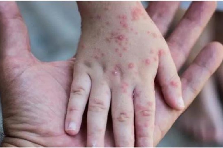 مختص في علم الفيروسات: تونس لازالت في مأمن من “جدري القردة”