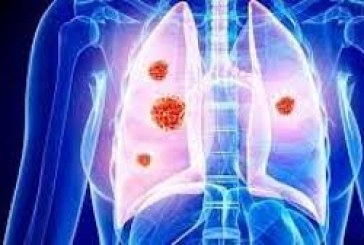دراسة: قد تصاب بسرطان الرئة حتى لو لم تدخن