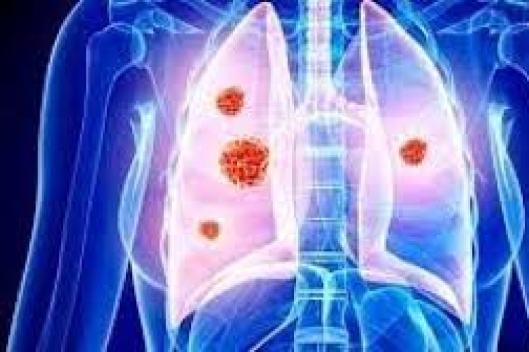 دراسة: قد تصاب بسرطان الرئة حتى لو لم تدخن