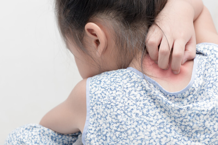 ‫الأطفال ايضا مهددون بالصدفية