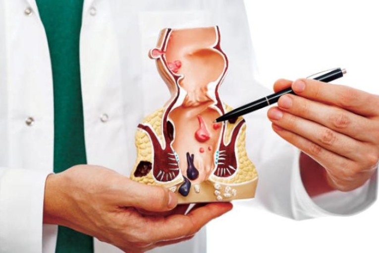 آلام البواسير… مشكلة شائعة لا تحتمل التأجيل