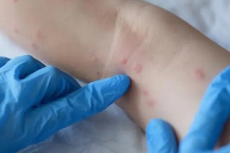 مختص في علم الفيروسات يشدد على أهمية التّوقي من عدوى ‘جدري القردة’